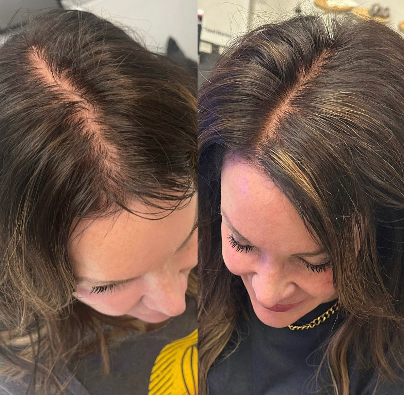 A woman who recently received a Keravive treatment showing thicker hair